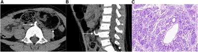 Case report: The CT features of pediatric retroperitoneal extrarenal Wilms tumor: a report of two cases and literature review
